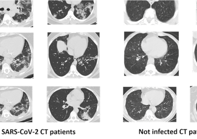xDNN for SARS-CoV-2 identification in patient CT scans